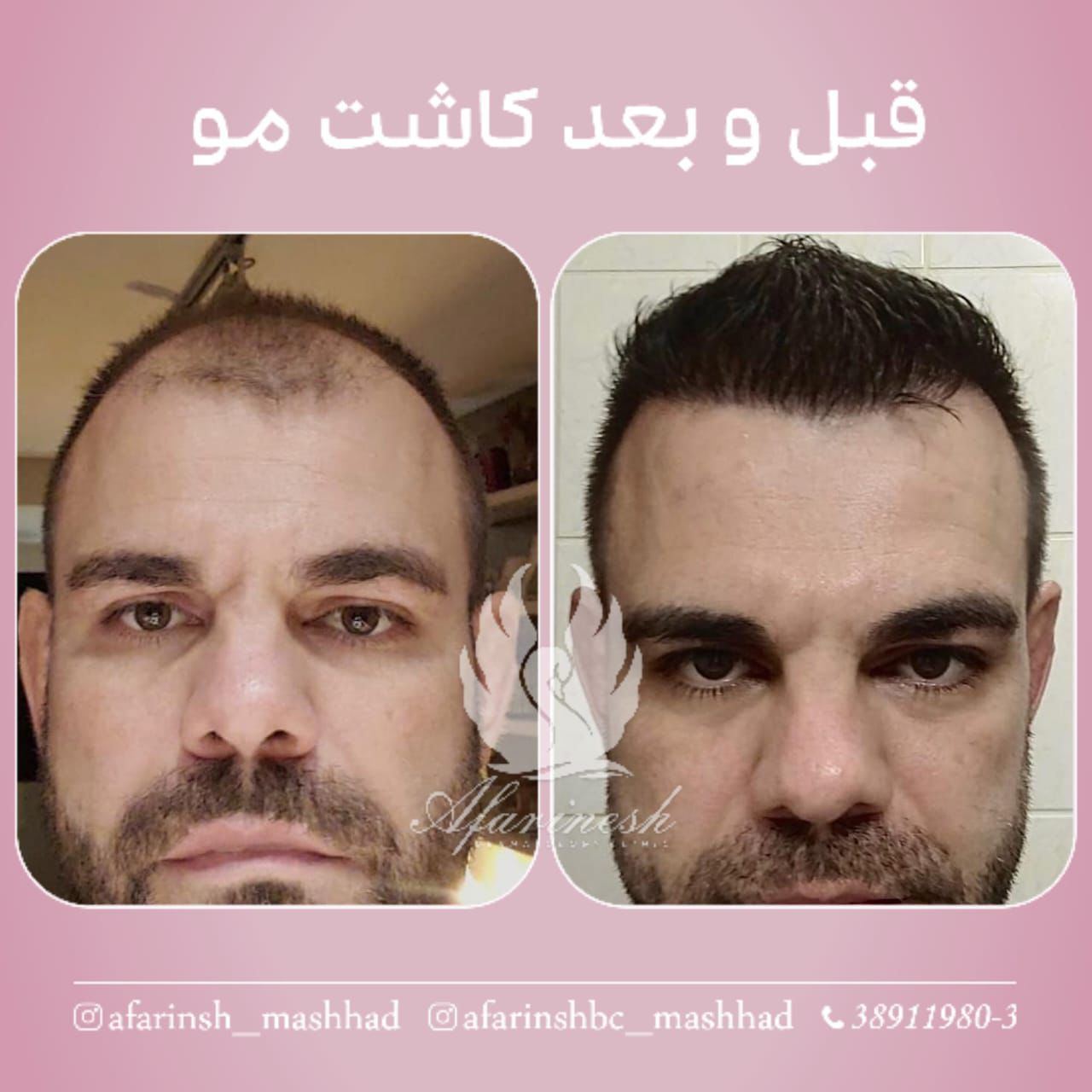 کاشت مو در مشهد