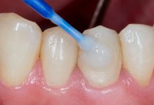 بهترین سمان دائم دندانپزشکی کدام است؟