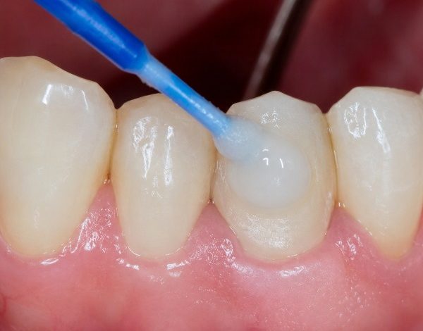 بهترین سمان دائم دندانپزشکی کدام است؟